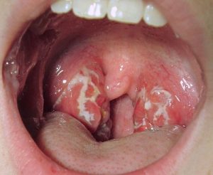 علاج التهاب الحلق مع أو بدون مضادات ?حيوية