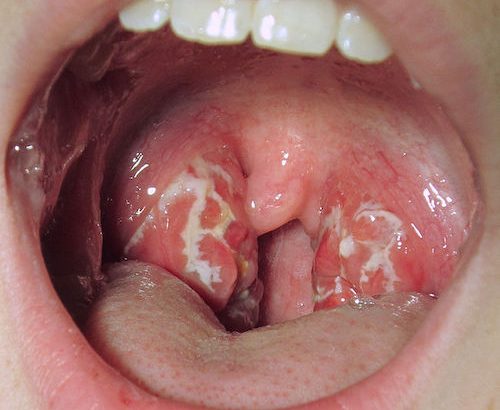 علاج التهاب الحلق