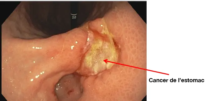 اعراض سرطان المعدة